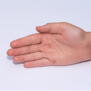 3. الثآليل المسطحة (Flat Warts)