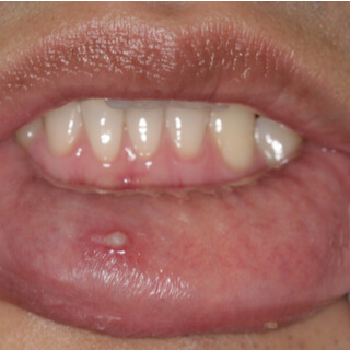 4. الثآليل الخيطية (Filiform Warts)
