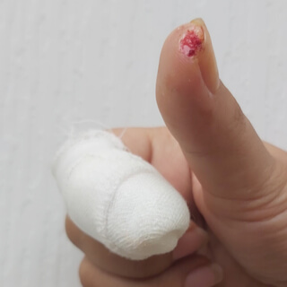 5. الثآليل المحيطة بالزغب (Periungual Warts)