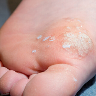 6. ثآليل الفسيفساء (Mosaic Warts)