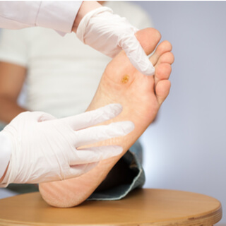 تشخيص الثآليل