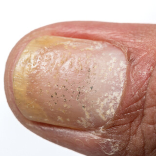 أنواع مرض الصدفية