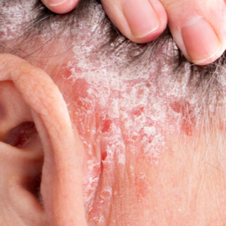 أنواع مرض الصدفية