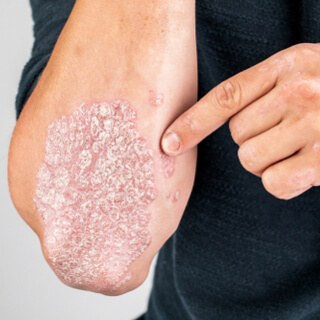 أنواع مرض الصدفية