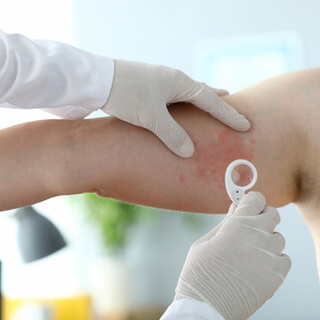 تشخيص مرض الصدفية