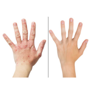 مدّة مرض الصدفية