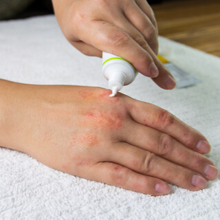 علاج مرض الصدفية