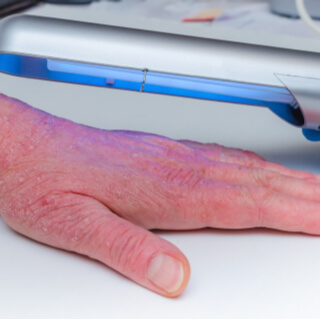 علاج مرض الصدفية المتقدم