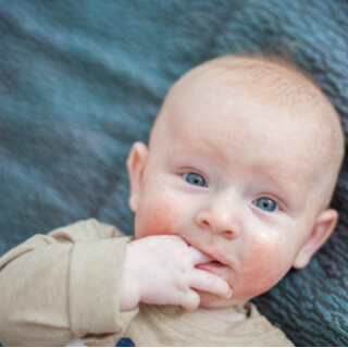 1. التهاب الجلد التأتبي (Atopic Dermatitis)