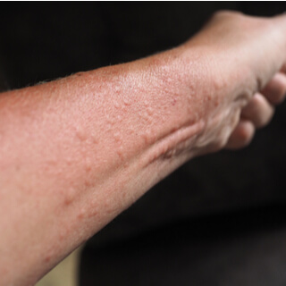 2. التهاب الجلد التماسي (Contact dermatitis) 