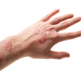 3. التهاب الجلد العصبي (Neurodermatitis)