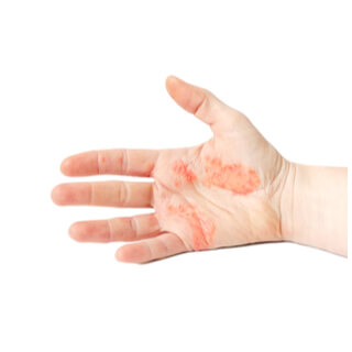 4. أكزيما خلل التعرق (Dyshidrotic eczema)