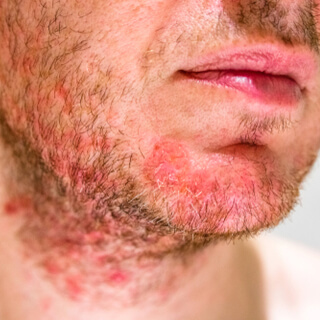 5. التهابَ الجلدِ المَثِّيّ (Seborrheic dermatitis)