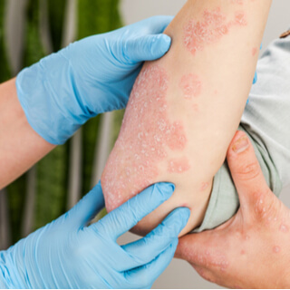 6. التِهاب الجلد الدِّرهميّ (Nummular eczema)