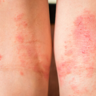 7. التهاب الجلد الركودي (Stasis dermatitis)