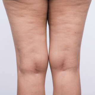 1.السيلوليت الناتج عن الوذمة (Edematous cellulite)