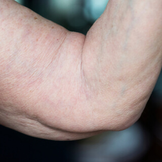 2. السيلوليت الناتج عن ارتخاء الجلد (Loose Skin Cellulite)