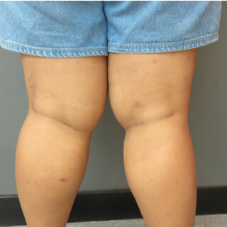 6. السيلوليت الناتج بسبب الجينات (Genetic cellulite)