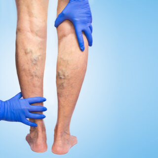 أعراض الدوالي عند الحامل أعراض الدوالي عند الحامل