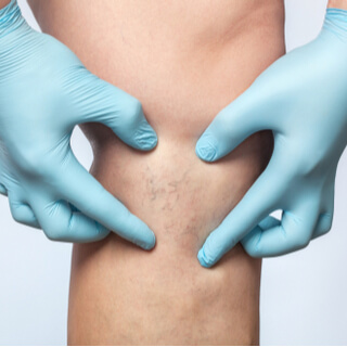 علاج الدوالي عند الحامل علاج الدوالي عند الحامل