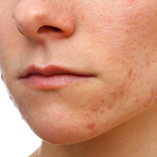 الطفح الجلدي