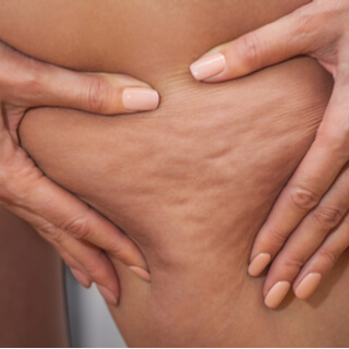 شكل السيلوليت بالصور