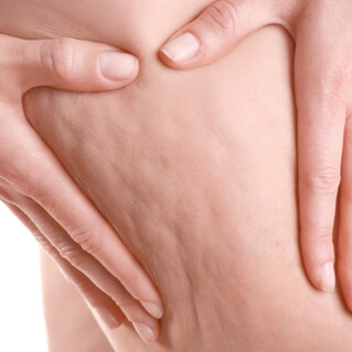 شكل السلوليت العام