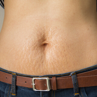 درجات السيلوليت 