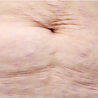 كيف ينشأ السيلوليت؟