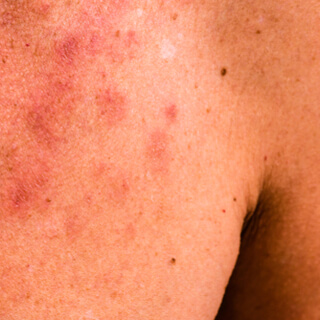 أنواع فيروس hpv وأعراضه أنواع فيروس hpv وأعراضه