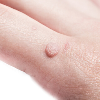 2. الثآليل الشائعة (Common warts) 2. الثآليل الشائعة (Common warts)