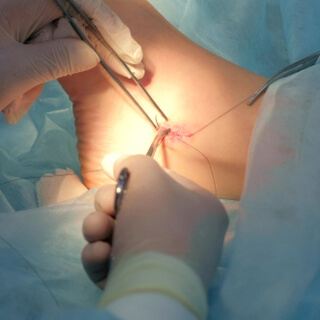 علاج الكاحل الجراحي