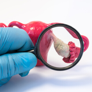 5. متلازمة تكيس المبايض (Polycystic ovary syndrome)