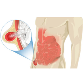 1. الفتق الإربي
