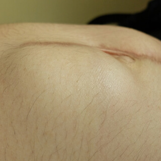 5. فتق جدار البطن