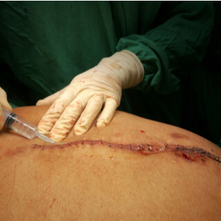 6. الفتق الجراحي