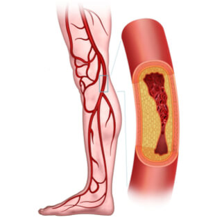 2. أمراض الشرايين الطرفية (Peripheral Artery Disease)