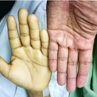 4. فقر الدم  (Anemia)