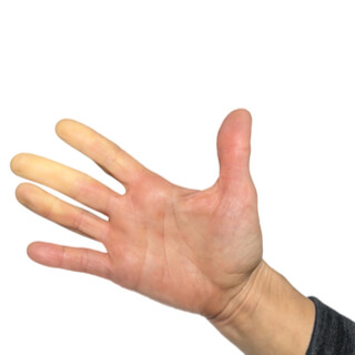 5. مرض رينود (Raynaud’s Disease)