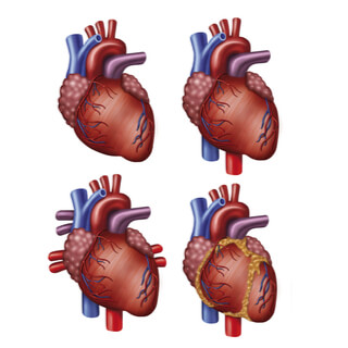 1. جدران القلب (Heart Walls)