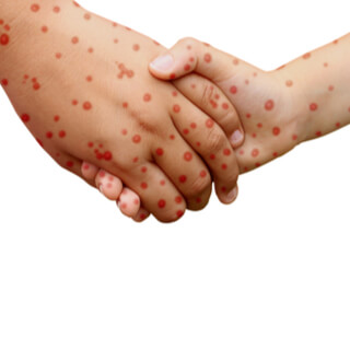 1. العدوى 1. العدوى