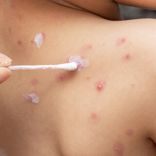 4. العلاج 4. العلاج