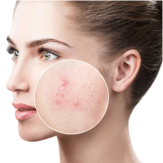 أسباب ظهور حب الشباب