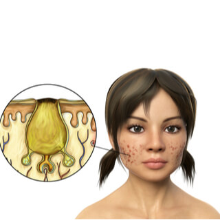 1. انسداد الغدد الدهنية