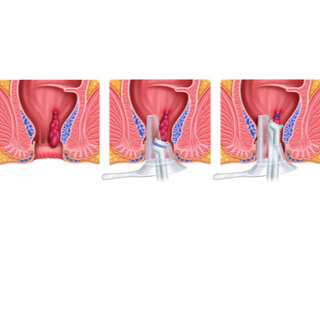 1. الجراحة بدون تخدير