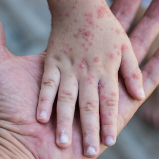 1. العدوى 1. العدوى