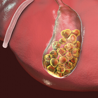 6. تقليل خطر الإصابة بحصوات المرارة