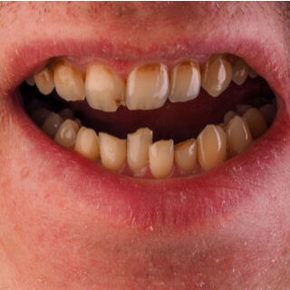 لماذا يتم تلبيس الأسنان الأمامية؟