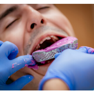 كيفية تلبيس الأسنان الأمامية باستخدام الطريقة التقليدية