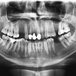 كيفية تلبيس الأسنان الأمامية في يوم واحد